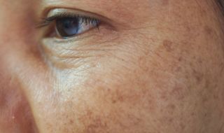 5 храни, които водят до появата на бръчки