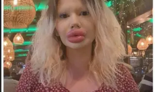 Българското Барби: Може да ослепея от хиалурона, но няма да спра!