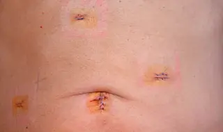 Ново откритие позволява на кожата да заздравява без белези