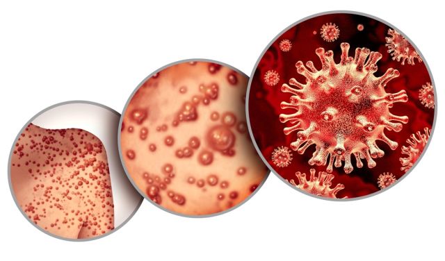 Великобритания ще ваксинира гейове и бисексуални срещу маймунска шарка