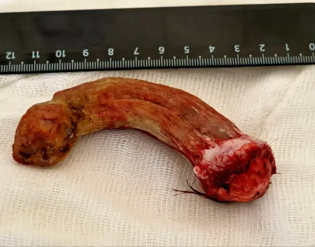 Премахнаха 13-сантиметров рог, възходящ от главата на мъж