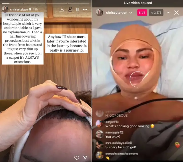 Криси Тейгън понижи челото си с пластична операция