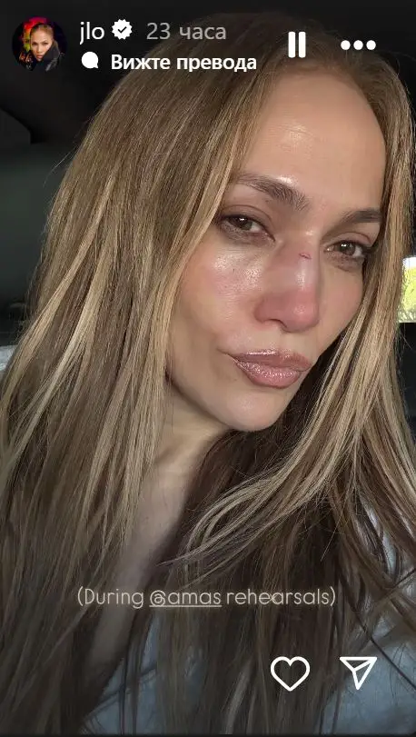  Дженифър Лопес с шевове на лицето след подготовки за Американските музикални награди (СНИМКА) 