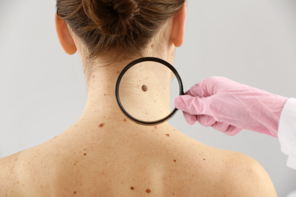 Това са сигурни признаци за рак на кожата