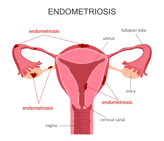 Лекар изброи най-честите признаци и симптоми на ендометриоза