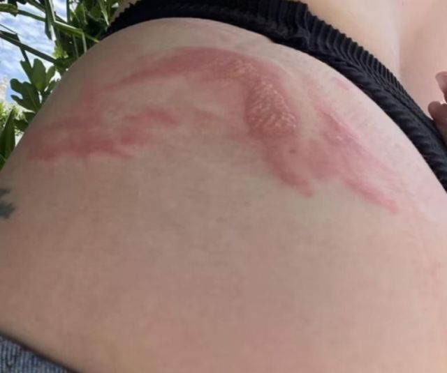 Отровни насекоми обезобразиха кожата на млада майка на Бали 