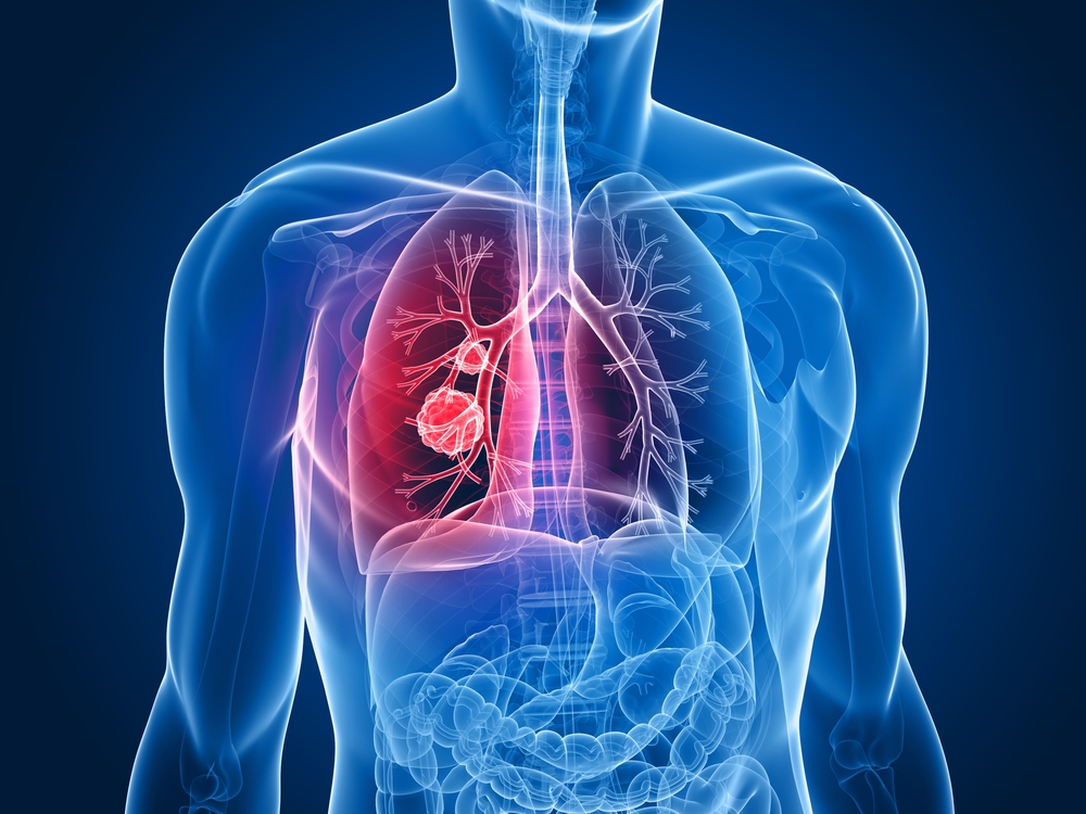 Колко дълго живеят хората с диагноза рак на белия дроб?