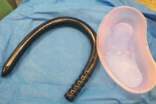 Мъж попадна в болница след злополука със секс играчка дълга 77 см (СНИМКА)