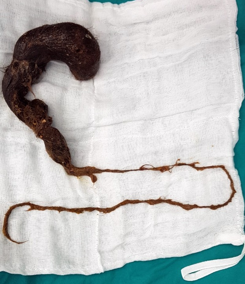 Плевенски хирурзи извадиха топка косми от стомаха на 12-годишно момиче