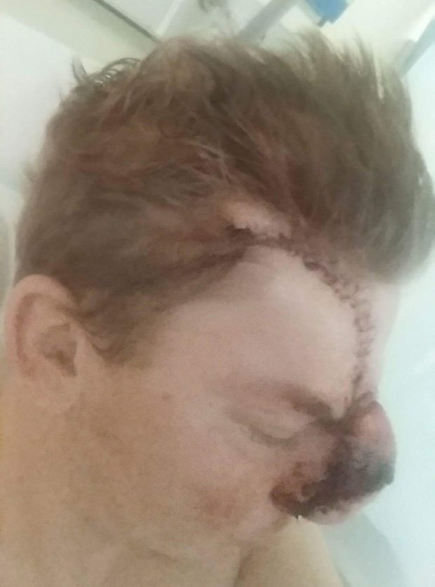 Мъж остана с половин нос след кръчмарски бой с непознат